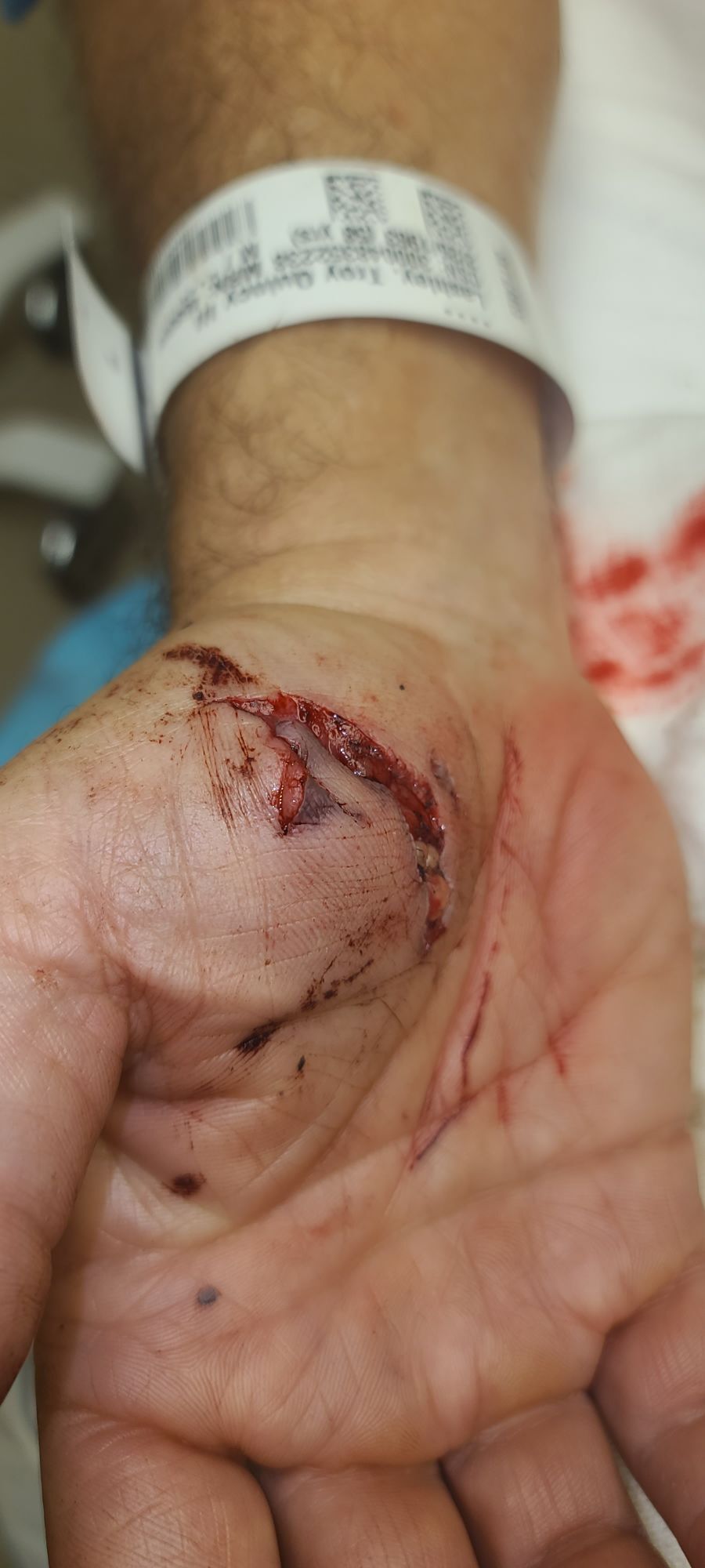 Troy's hand injury